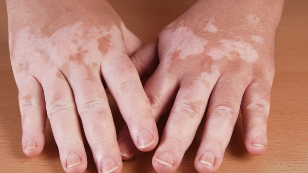 白癜风外用药有哪些 得了白癜风需要注意哪些细节