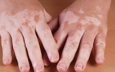 白癜风怎么预防最有效 身体皮肤变白就是白癜风吗？