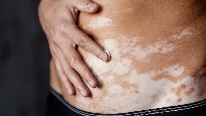 白癜风发病的病因有哪些总结几点易引发白癜风的病因