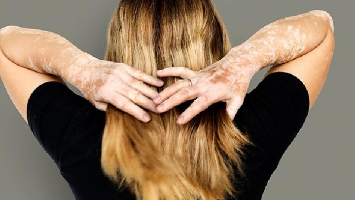 早期白癜风的症状是什么样的注意这些白癜风的早期症状