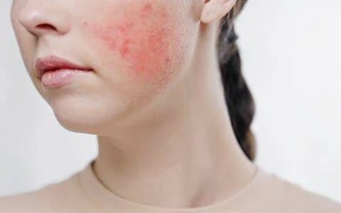 春季皮肤经常过敏的原因