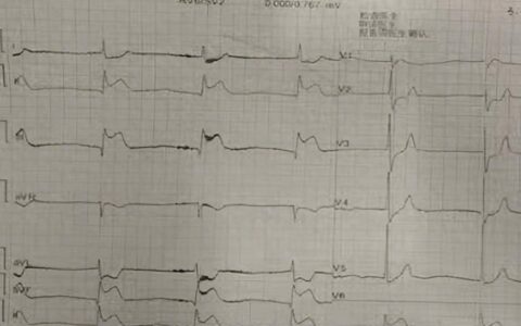 76岁老人摔伤后出现腰腹痛，竟被诊断为“急性心肌梗死”！