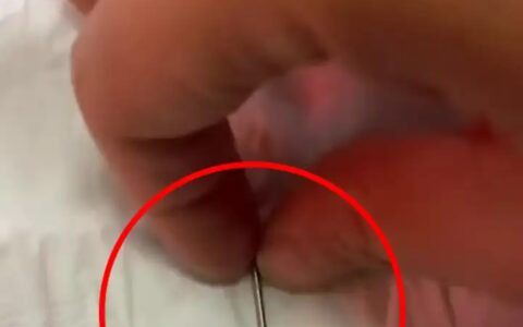 保定一男子猪肉中吃出3厘米长针头，嘴被扎伤连夜就医，该咋赔？