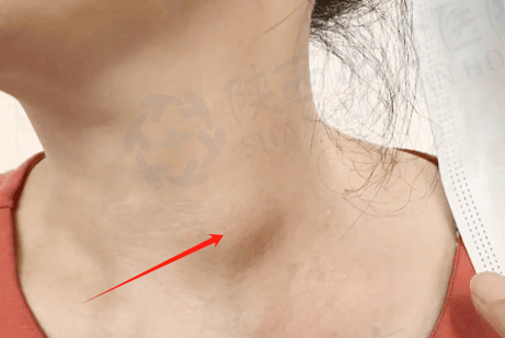 甲状腺结节并不等同于癌!良、恶性各有什么超声特征?-恶性甲状腺结节超声提示