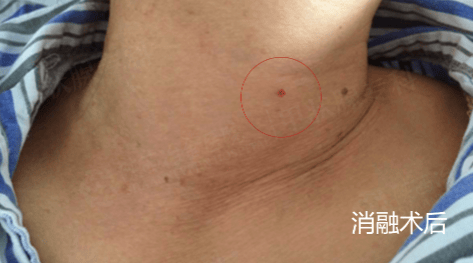 甲状腺结节并不等同于癌!良、恶性各有什么超声特征?-恶性甲状腺结节超声提示