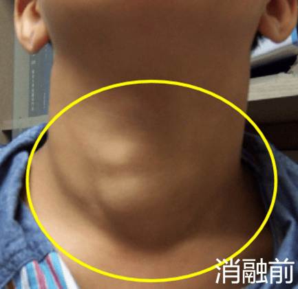 甲状腺结节并不等同于癌!良、恶性各有什么超声特征?-恶性甲状腺结节超声提示