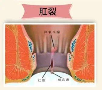 【广州建康医院是正规的】护菊小贴士｜肛肠问题知多少？-广州建康医院简介