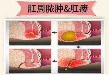 【广州建康医院是正规的】护菊小贴士｜肛肠问题知多少？-广州建康医院简介